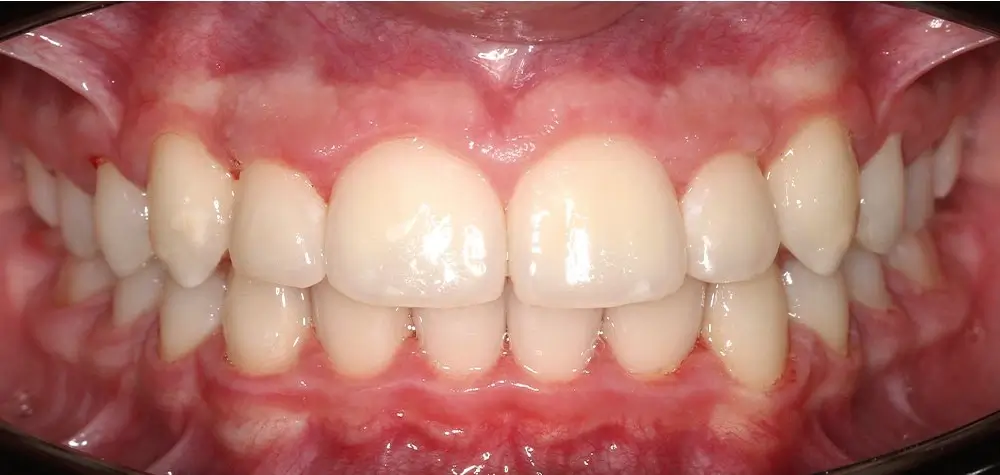 Скученность - Кейс 26 — вид спереди после леч ения