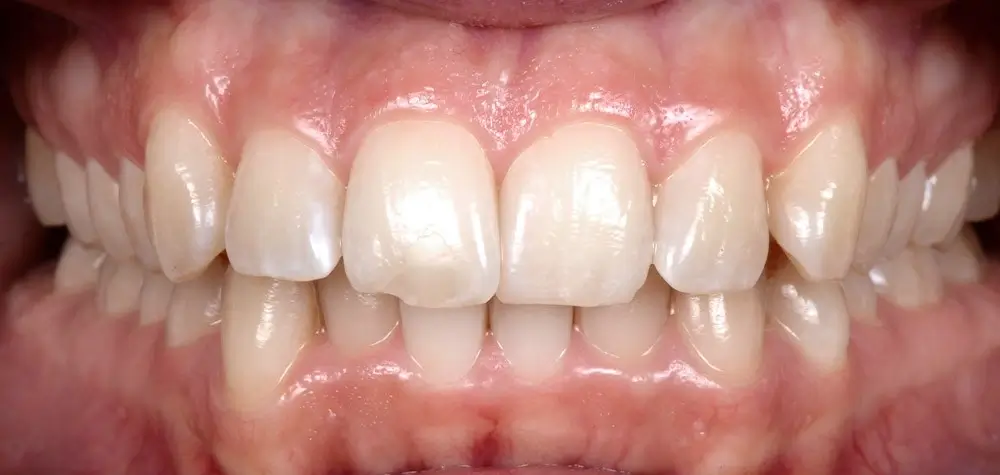 Скученность - Кейс 3 — вид спереди до лечения