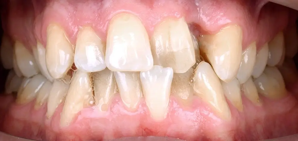 Скученность - Кейс 4 — вид спереди до лечения