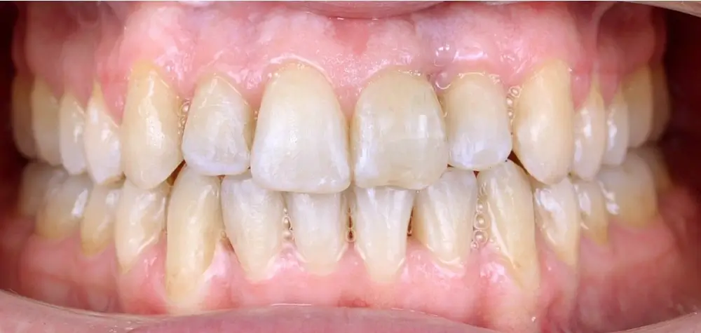 Скученность - Кейс 4 — вид спереди после лечения