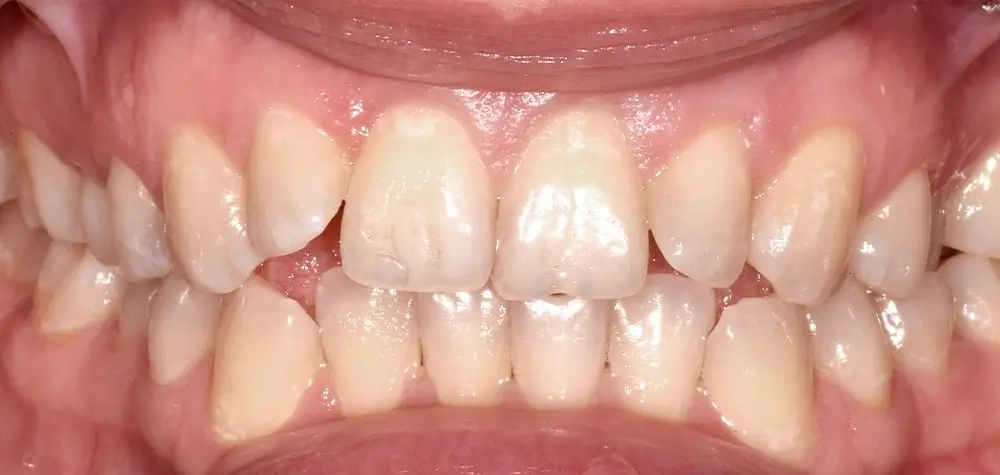 Открытый прикус - Кейс 1 — фронтальный ракурс до лечения