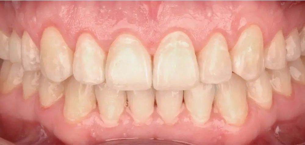 Открытый прикус - Кейс 1 — фронтальный ракурс после лечения