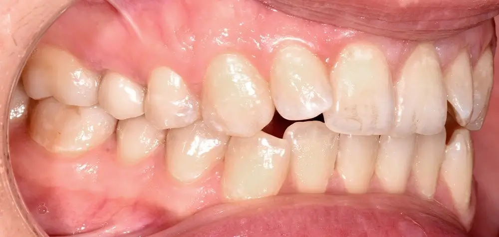 Открытый прикус - Кейс 1 — боковой ракурс до лечения