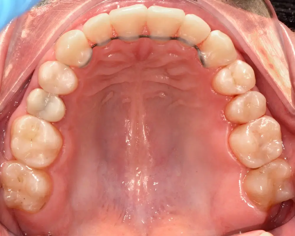 Открытый прикус - Кейс 1 — верхняя челюсть после лечения