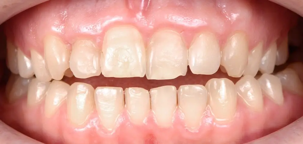 Открытый прикус - Кейс 2 — фронтальный ракурс до лечения