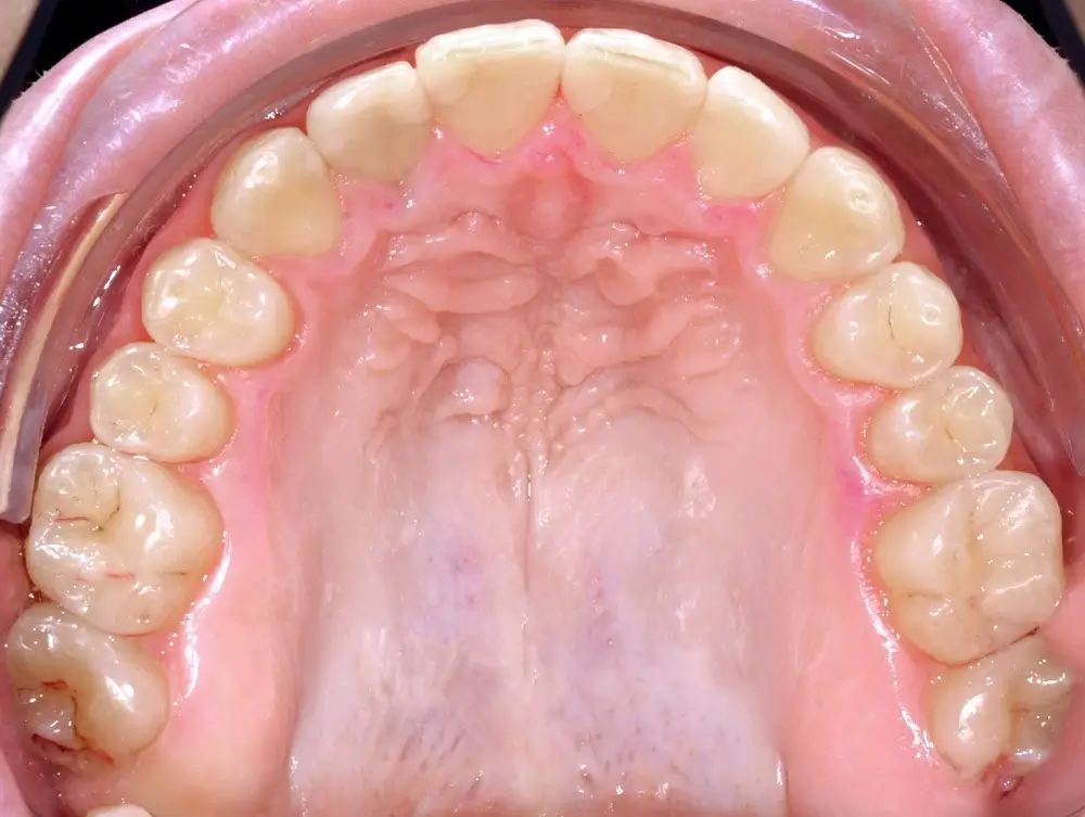 Открытый прикус - Кейс 2 — верхняя челюсть после лечения