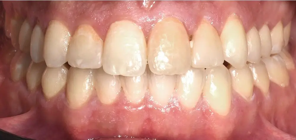 Открытый прикус - Кейс 3 — фронтальный ракурс после лечения