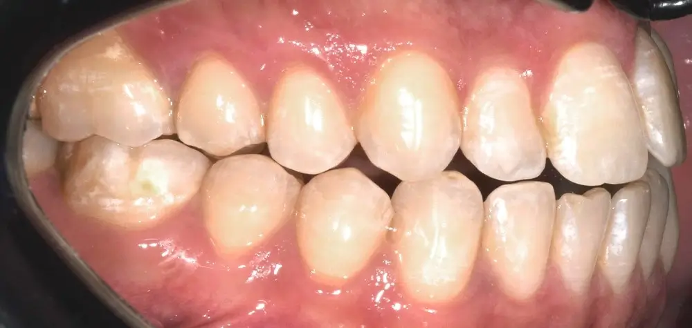 Открытый прикус - Кейс 3 — боковой ракурс до лечения