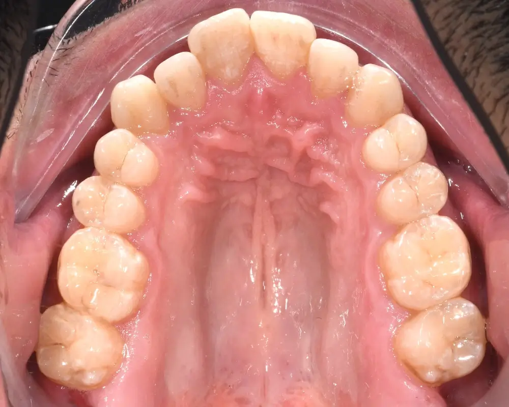 Открытый прикус - Кейс 3 — верхняя челюсть до лечения