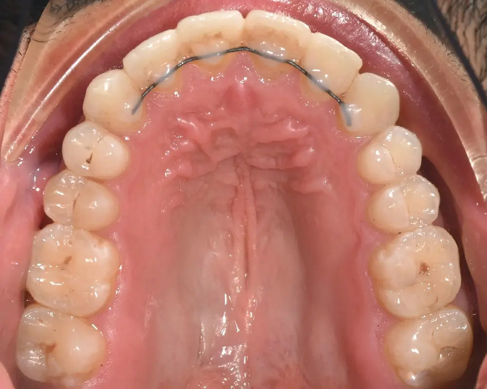 Открытый прикус - Кейс 3 — верхняя челюсть после лечения