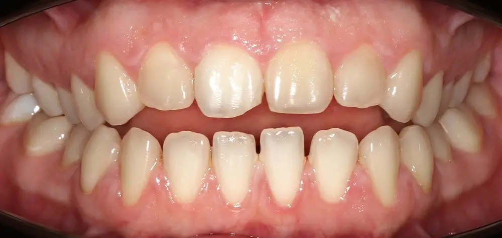 Открытый прикус - Кейс 4 — фронтальный ракурс до лечения