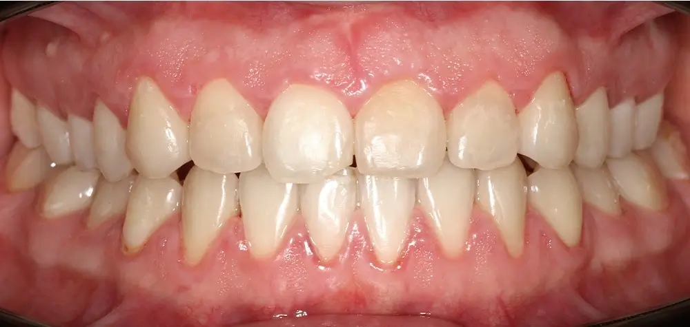 Открытый прикус - Кейс 4 — фронтальный ракурс после лечения