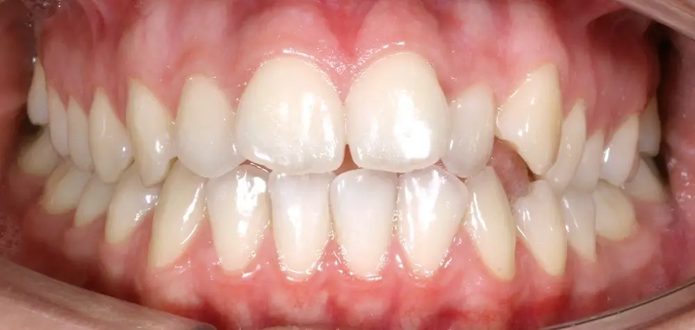 Открытый прикус - Кейс 6 — фронтальный ракурс до лечения