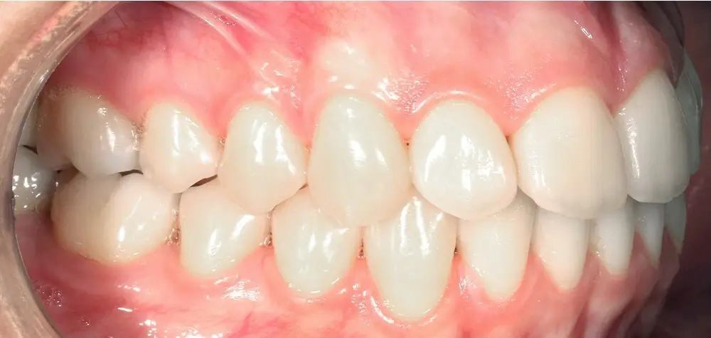 Открытый прикус - Кейс 6 — боковой ракурс после лечения